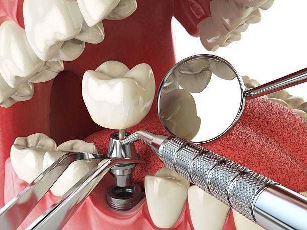 Best Emergency Root Canal Treatment in Cordry Sweetwater Lakes, IN
